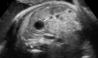 Splenic cysts.png