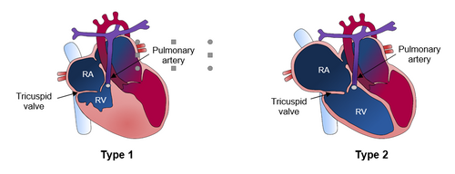 Pulmonary atresia image showing tricuspid valve is functioning and not functioning