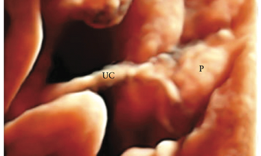 Placental variants.png