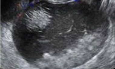 From detection to diagnosis the experts guide to adnexal masses.jpg