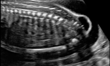 Spina bifida.jpg 1st tri