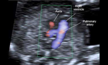 first trimester cardiac imaging.png