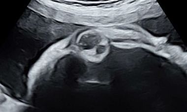 coloboma.jpg