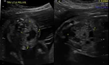 Ectopic Kidneys 1.png 2