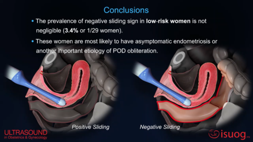 UOG video abstract: Prevalence of negative sliding sign representing