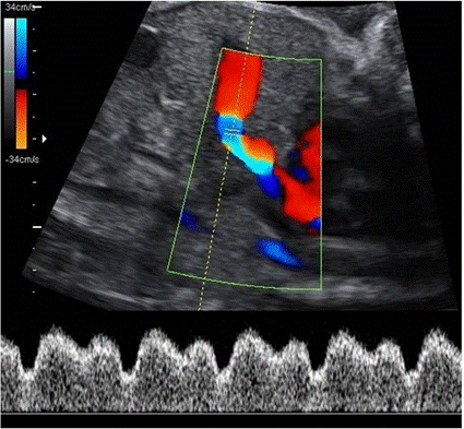 How to record ductus venosus blood velocity in the second half of pregnancy