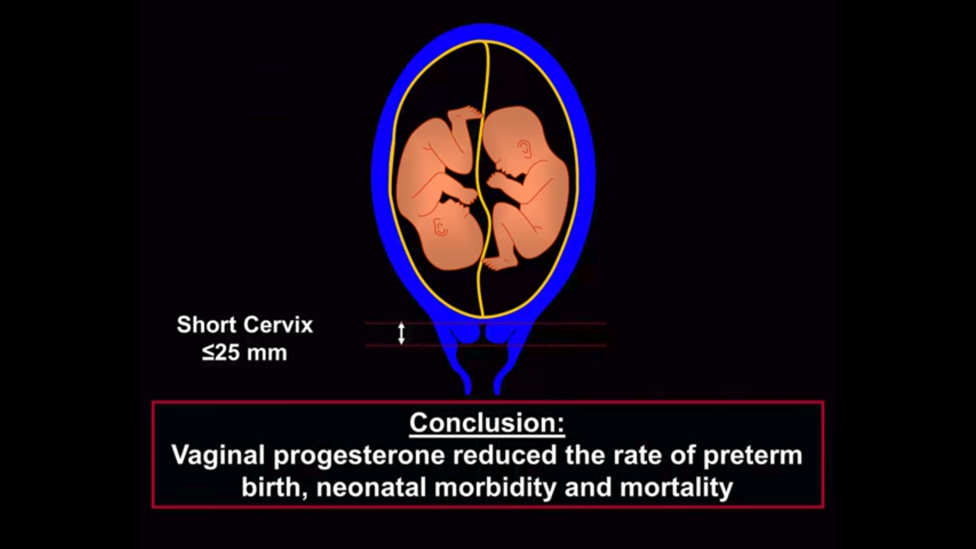 Vaginal progesterone decreases preterm birth and neonatal morbidity and